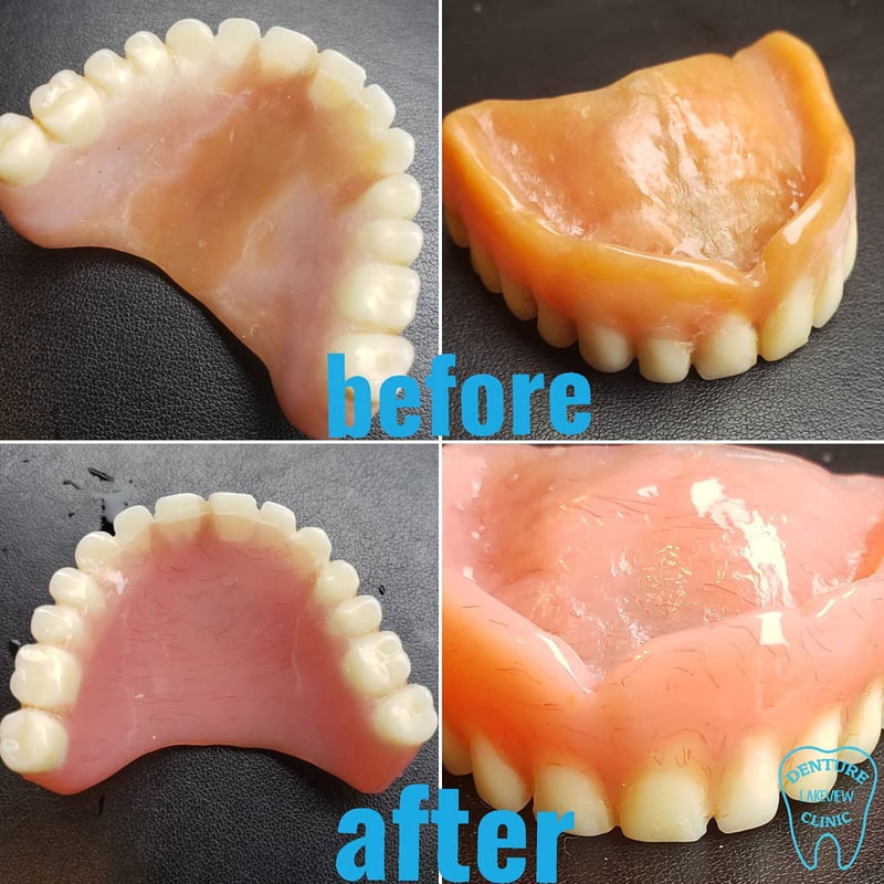 before and after denture repair