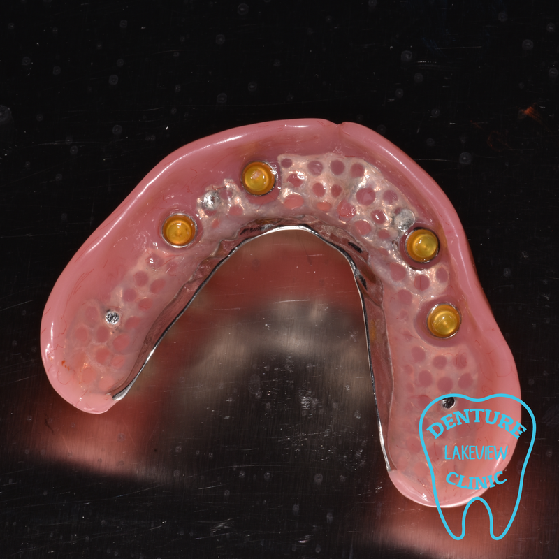 Implant supported upper denture with 4 locator implants