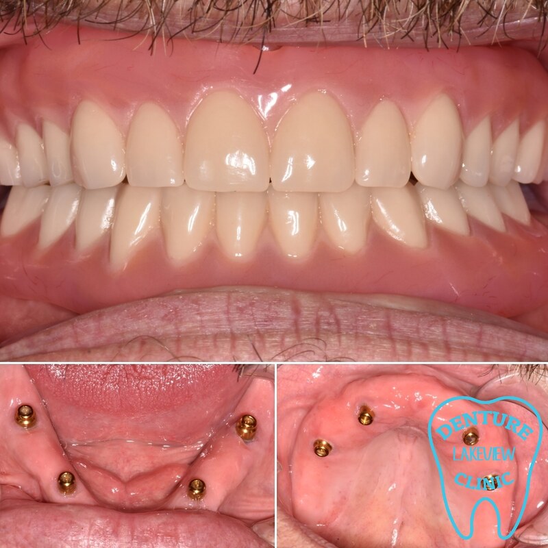 Full upper and lower dentures with 4 Zest locator abutment implant posts