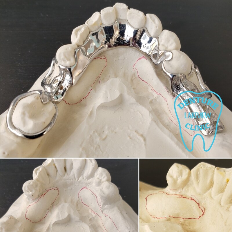 Cast metal denture